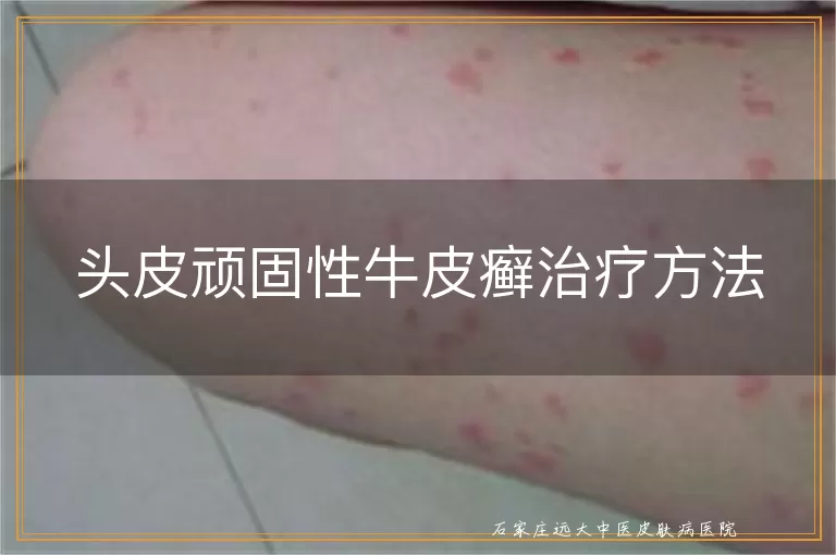 头皮顽固性牛皮癣治疗方法