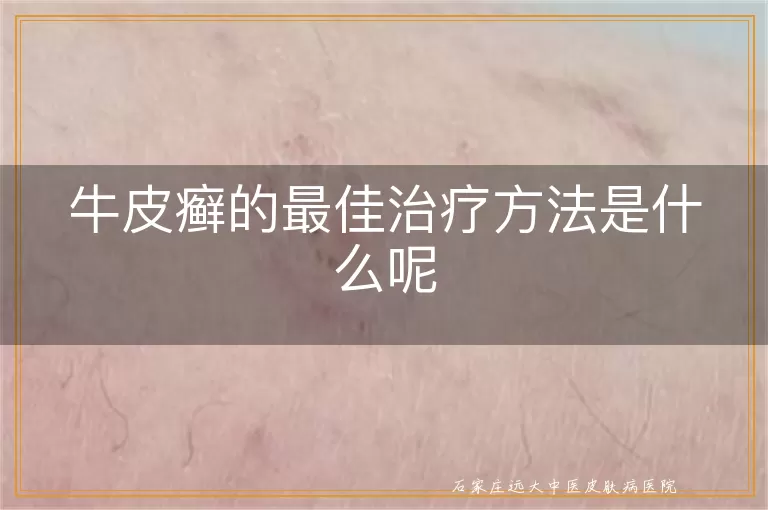 牛皮癣的最佳治疗方法是什么呢