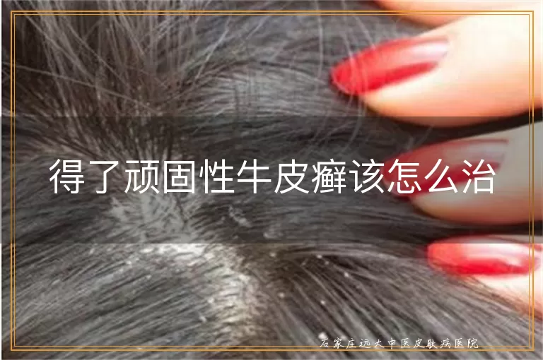 得了顽固性牛皮癣该怎么治