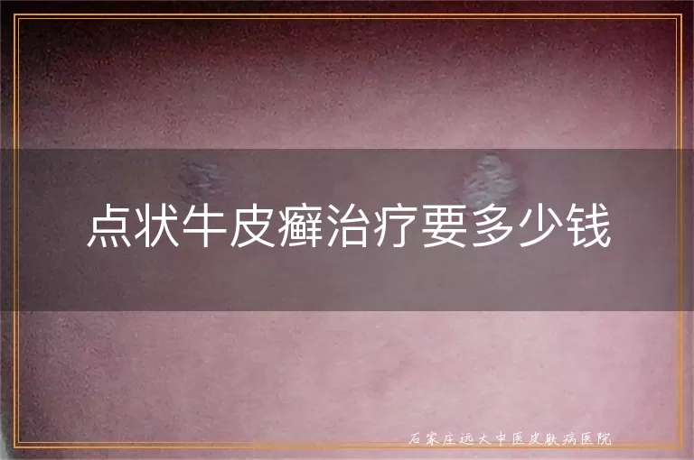 点状牛皮癣治疗要多少钱