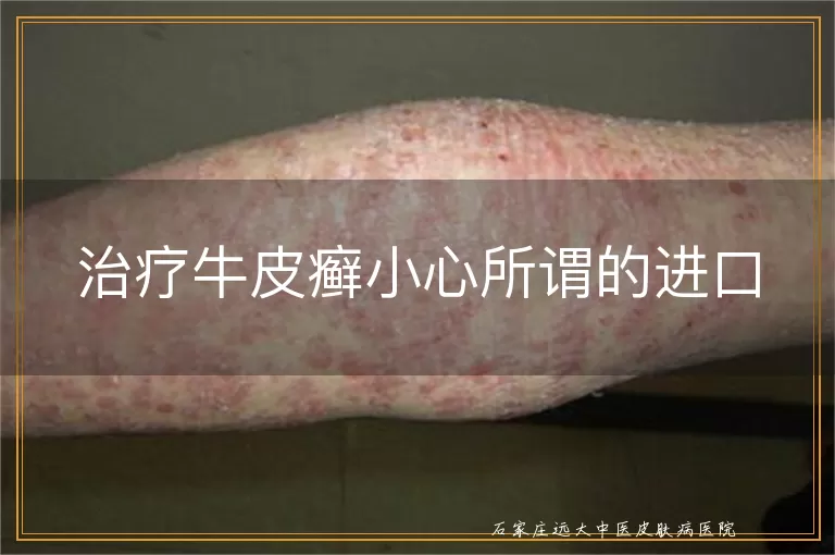 治疗牛皮癣小心所谓的进口