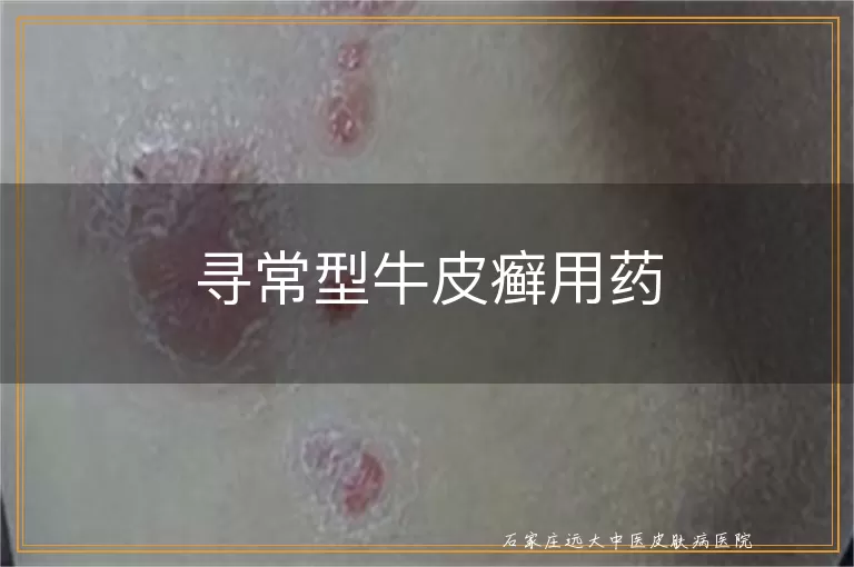 寻常型牛皮癣用药