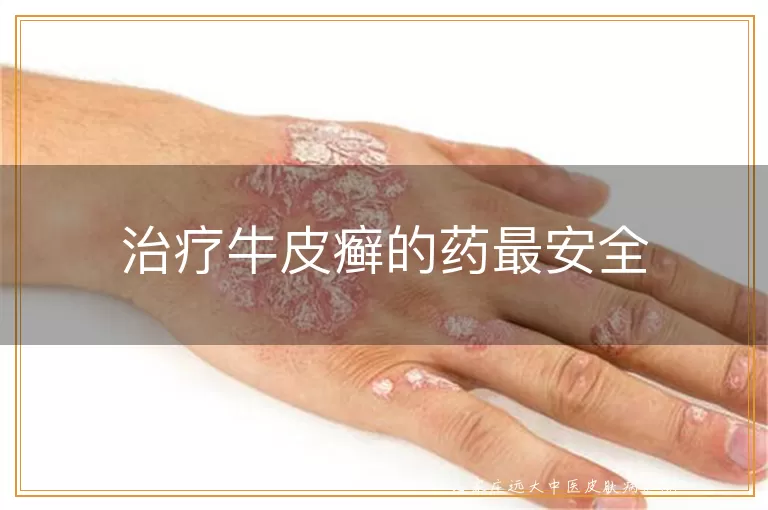 治疗牛皮癣的药最安全