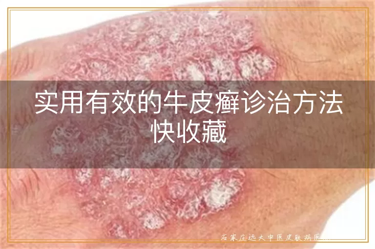 实用有效的牛皮癣诊治方法快收藏