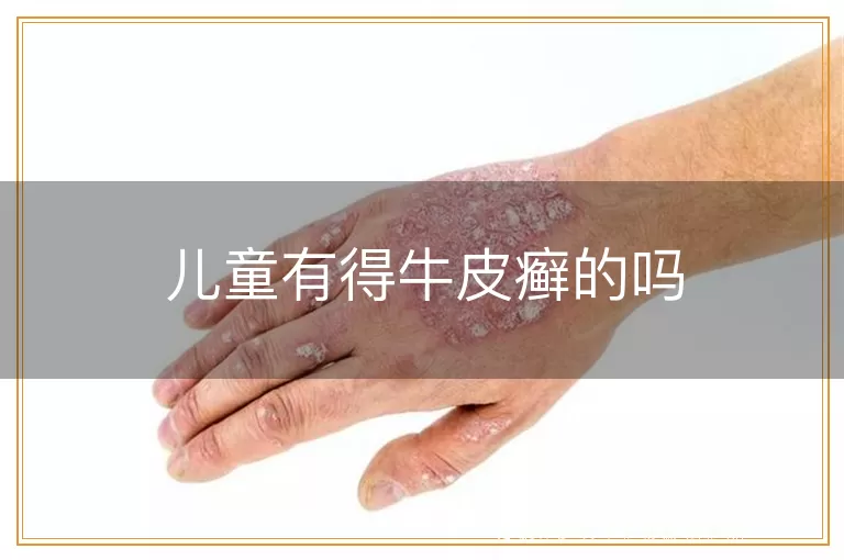 儿童有得牛皮癣的吗