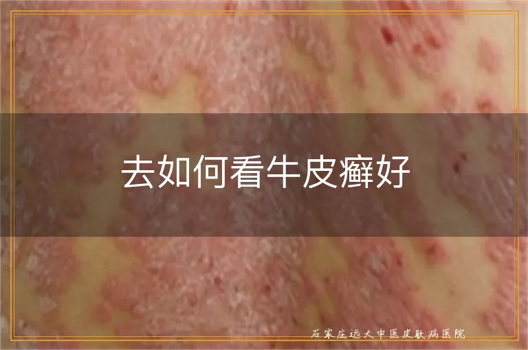 去如何看牛皮癣好
