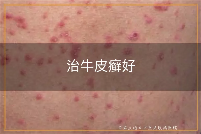 治牛皮癣好