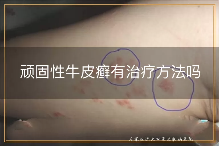 顽固性牛皮癣有治疗方法吗