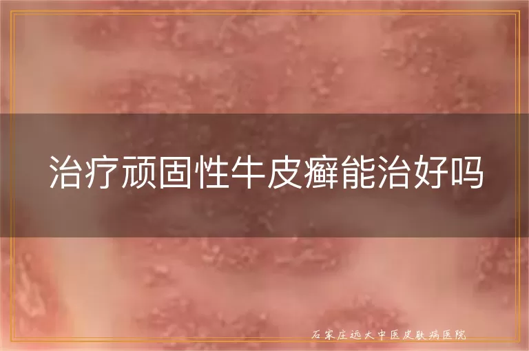 治疗顽固性牛皮癣能治好吗