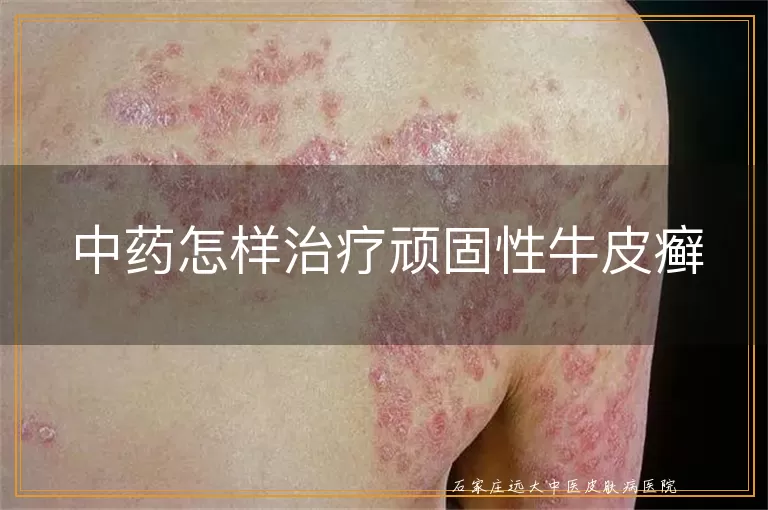 中药怎样治疗顽固性牛皮癣