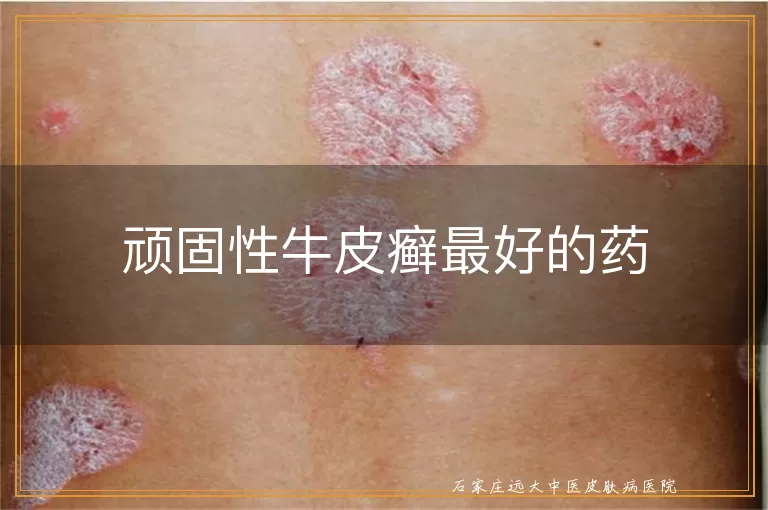 顽固性牛皮癣最好的药