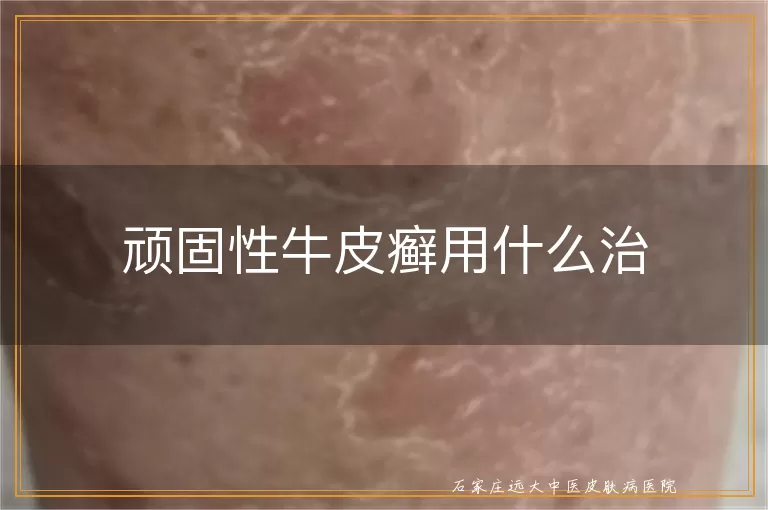 顽固性牛皮癣用什么治