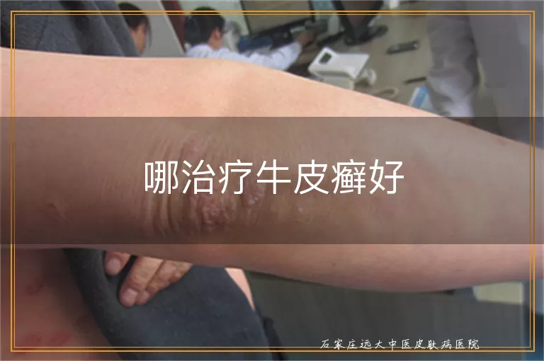 哪治疗牛皮癣好