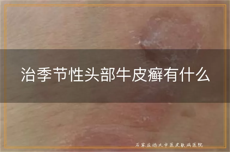 治季节性头部牛皮癣有什么