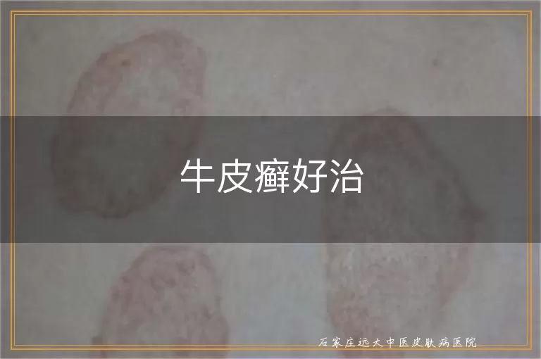 牛皮癣好治