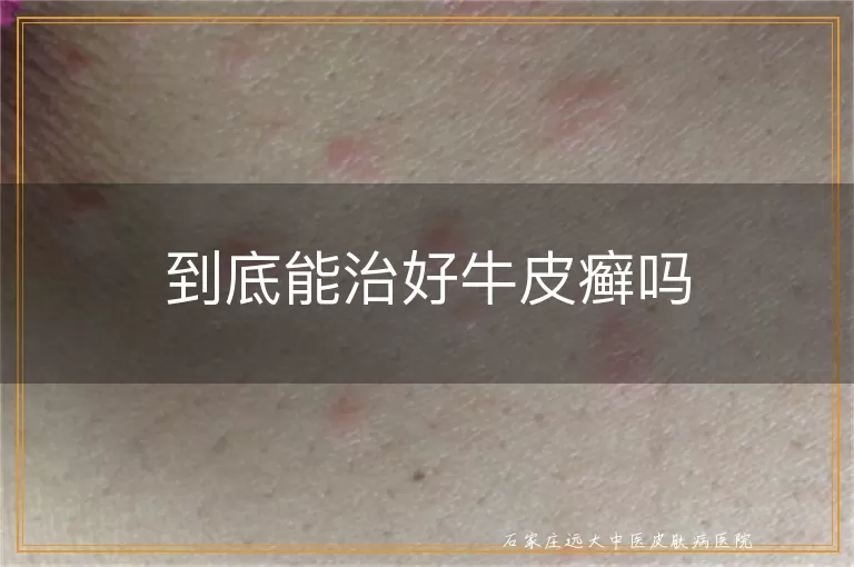 到底能治好牛皮癣吗