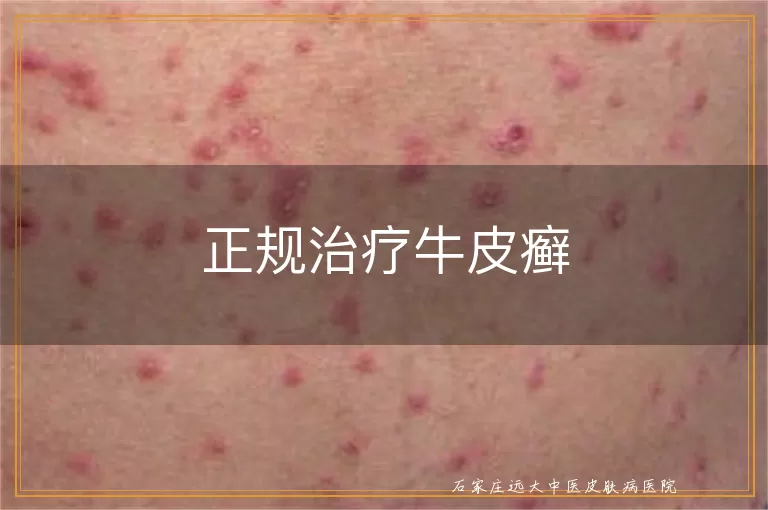 正规治疗牛皮癣