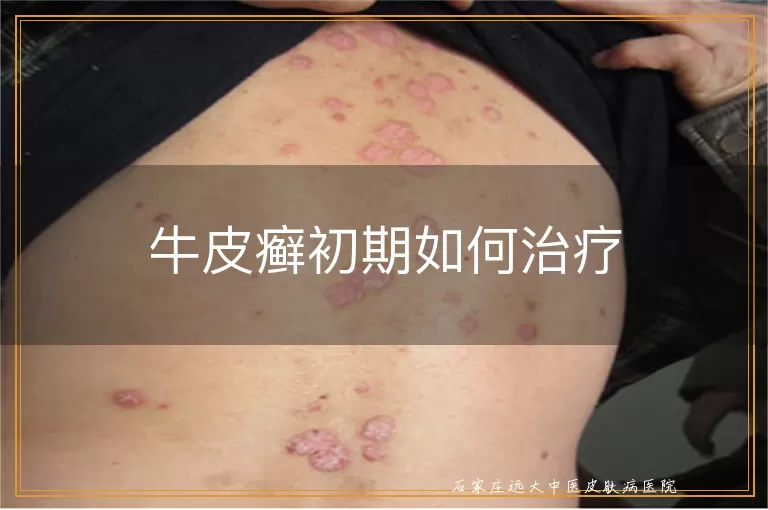 牛皮癣初期如何治疗