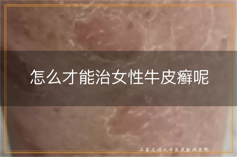 怎么才能治女性牛皮癣呢