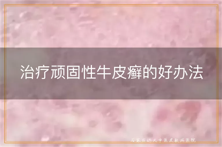 治疗顽固性牛皮癣的好办法