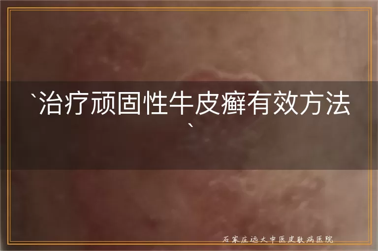 治疗顽固性牛皮癣有效方法