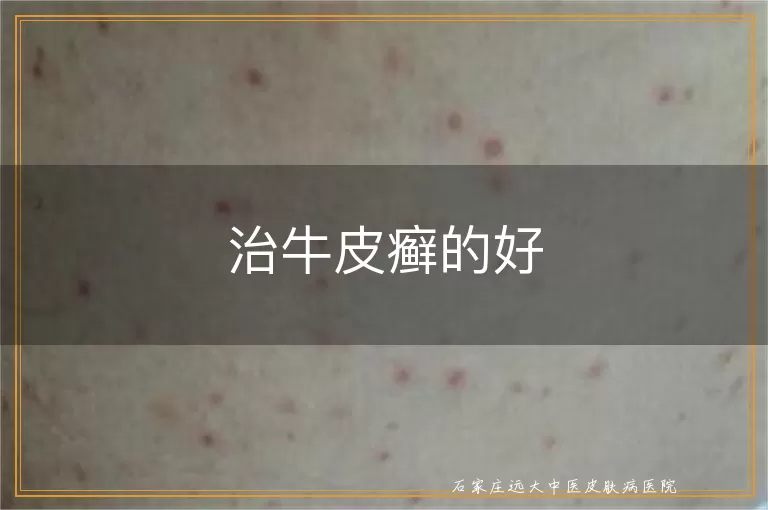 治牛皮癣的好