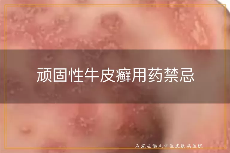 顽固性牛皮癣用药禁忌