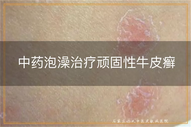 中药泡澡治疗顽固性牛皮癣
