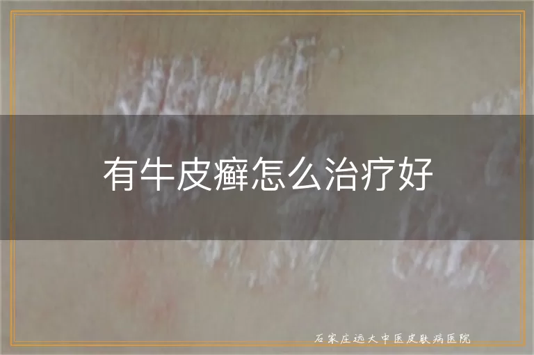 有牛皮癣怎么治疗好