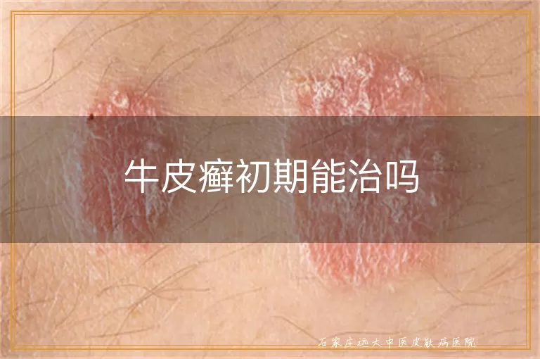 牛皮癣初期能治吗