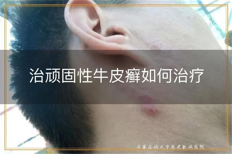 治顽固性牛皮癣如何治疗