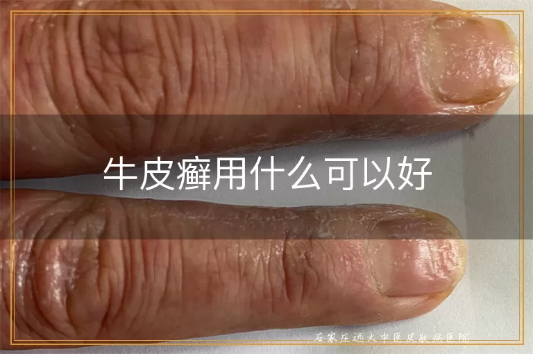 牛皮癣用什么可以好