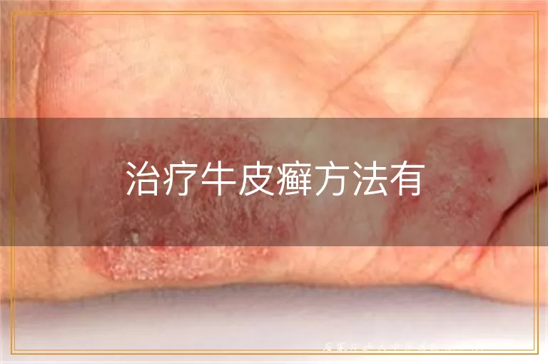 治疗牛皮癣方法有