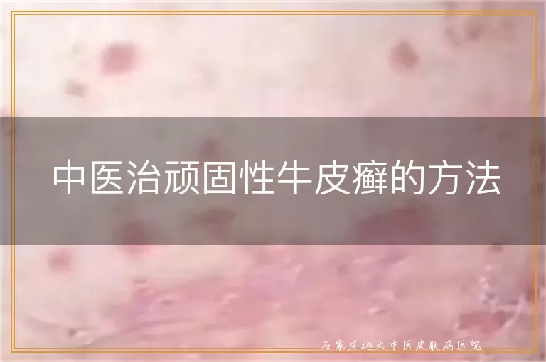 中医治顽固性牛皮癣的方法