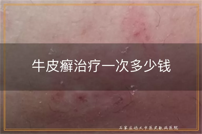 牛皮癣治疗一次多少钱