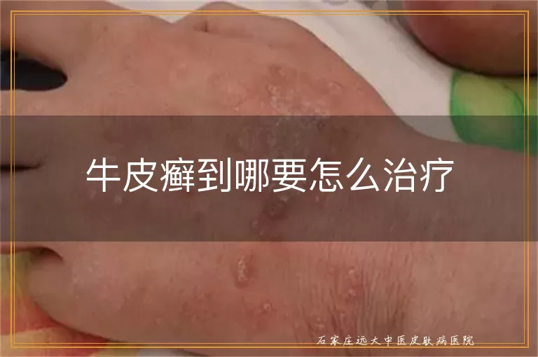 牛皮癣到哪要怎么治疗