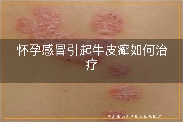 怀孕感冒引起牛皮癣如何治疗