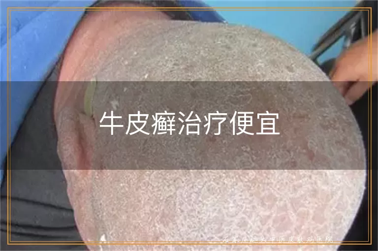 牛皮癣治疗便宜