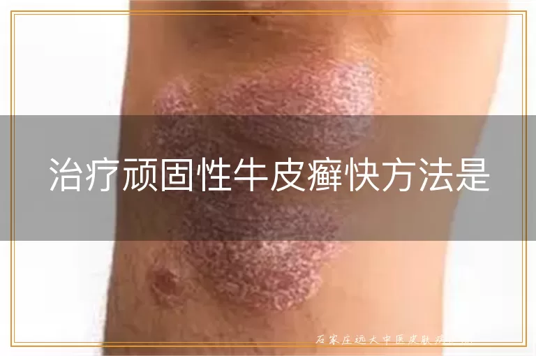 治疗顽固性牛皮癣快方法是