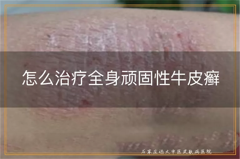 怎么治疗全身顽固性牛皮癣