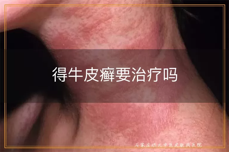 得牛皮癣要治疗吗