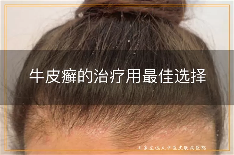 牛皮癣的治疗用最佳选择