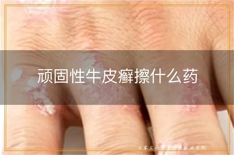 顽固性牛皮癣擦什么药