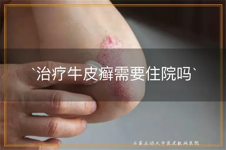治疗牛皮癣需要住院吗