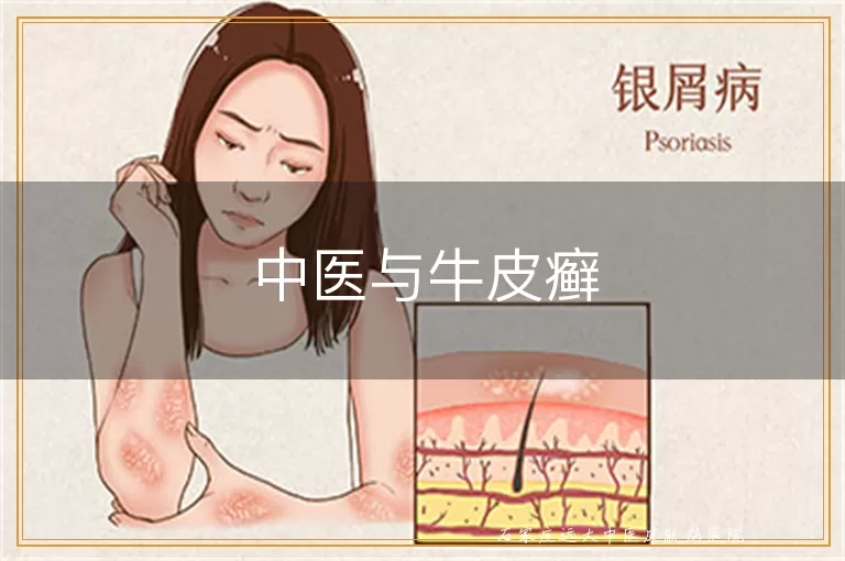 中医与牛皮癣
