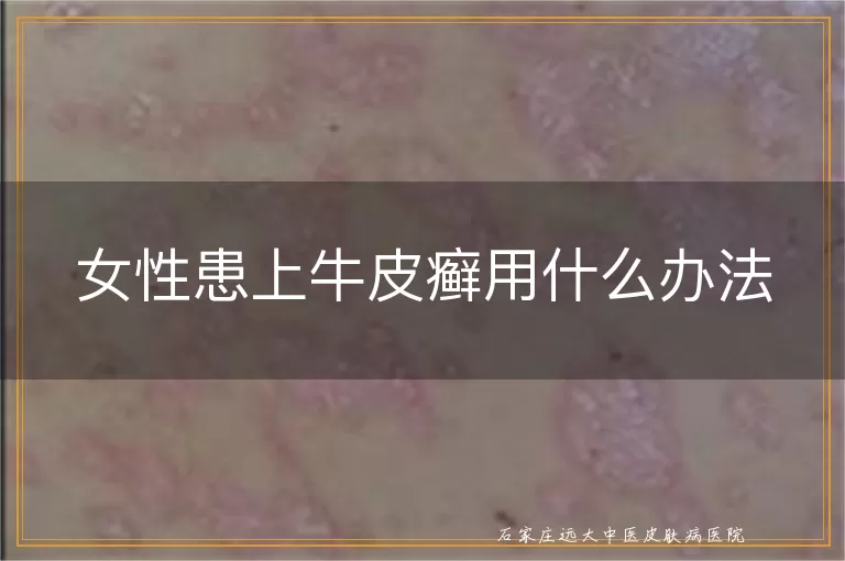 女性患上牛皮癣用什么办法