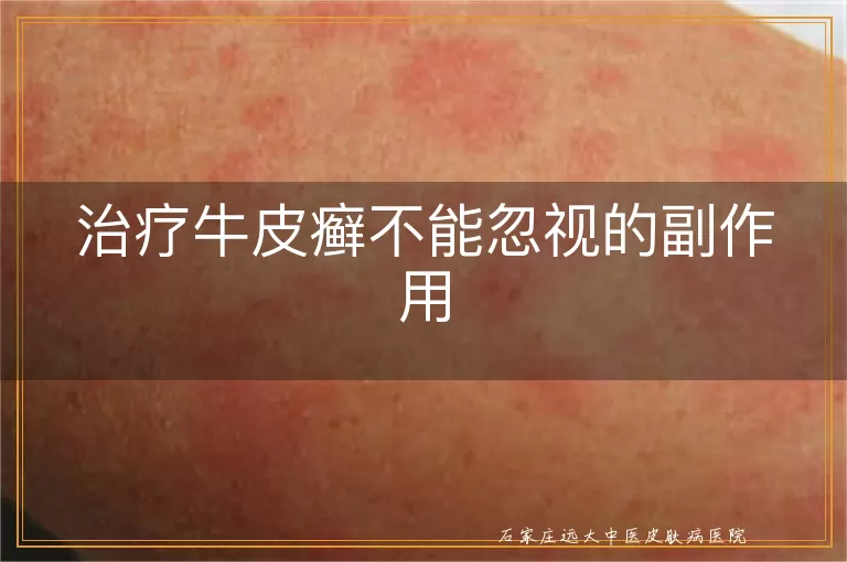 治疗牛皮癣不能忽视的副作用