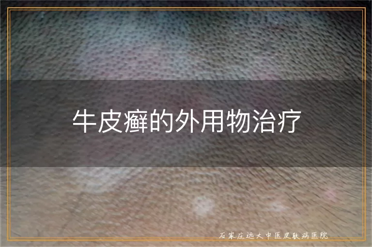 牛皮癣的外用物治疗