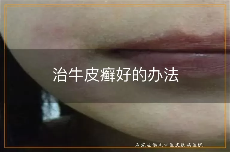 治牛皮癣好的办法