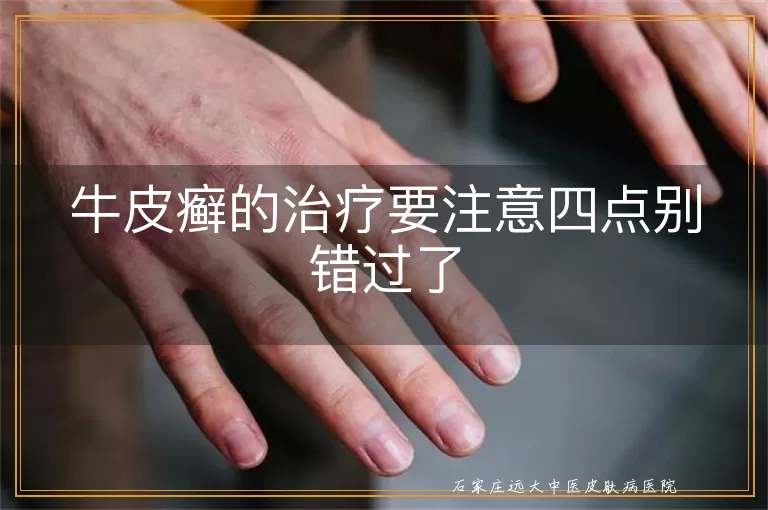 牛皮癣的治疗要注意四点别错过了